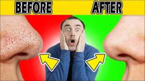 blackheads removal I Best way to remove Blackhead at Nose #Blackheads#Whiteheads.