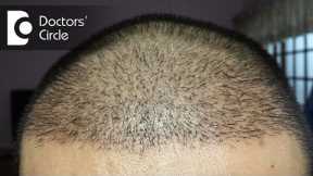 How long does it take for hair to grow after a hair transplant? - Dr. Madan Kumar BJ