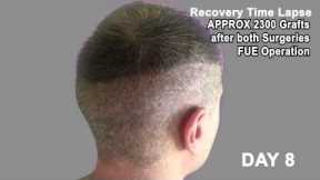 Hair Transplant Review 2013 19 DAY RECOVERY TIME LAPSE OF DONOR AREA POST OP