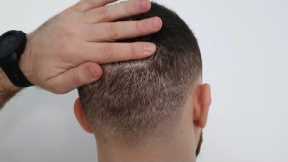 FUE Hair Transplant 8 MONTHS Results | Overharvested Donor Area?