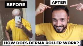 Derma Roller hair regrowth before and after | Does Micro-needling actually work in reducing DHT?