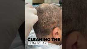 Head Wash After Hair Transplant | 1st Head Wash | Scabs Removal
