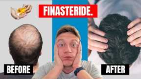 PEOPLE GOT THESE RESULTS WITH FINASTERIDE ALONE?! | REVIEW