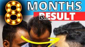 8 Months Hair Transplant Result | Before & After | HairMate Clinic Hair Transplant
