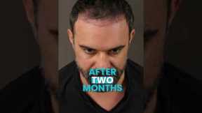 Hair Transplant Time Lapse at Vera Clinic #shorts #hairtransplant #hairtransplantturkey