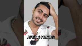 Six Months Hair Transplant Results | Latest Fue Technique #shorts #viral #hair transplant