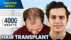 Grade 5 Hair Transplant in Surat | Stunning Hair Transplant Results and Cost #hairtransplant