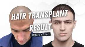 Hair Transplant Results | Hair Transplant  Time Lapse | Hair Transplant  Before and After