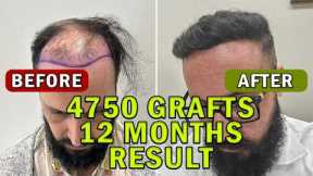 Hair Transplant Time Lapse 4750 Grafts 12 Months  FULL Journey l Hair Transplant Before & After