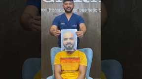 Before and After: The Incredible Sapphire FUE Hair Transplant Journey at CARA