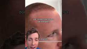 The Hair Transplant Timeline: What to Expect