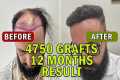 Hair Transplant Time Lapse 4750