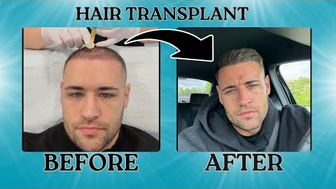 My Second Hair Transplant | 5 month Update