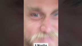 MONTH BY MONTH HAIR TRANSPLANT RESULT - BEFORE AND AFTER