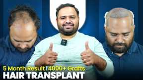 Grade 7 Baldness Hair Transplant in Pune | Amazing Hair Transplant Results & Cost in Pune