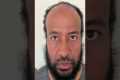 1 Year Afro Hair Transplant Turkey