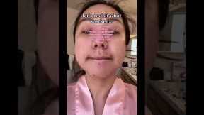 what ACTUALLY worked for my hormonal acne!