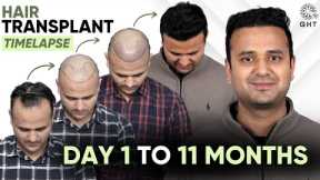 Hair Transplant Day 1 to 11 Months Result | Hair Transplant Timelapse | QHT Clinic | Hair Transplant