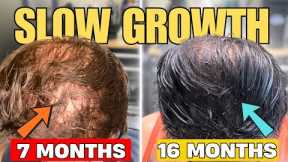 Slow Hair Transplant Growth? WATCH THIS!