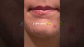 How I got rid of my pimple over night 👀 #acne #acneproneskin #skincareroutine