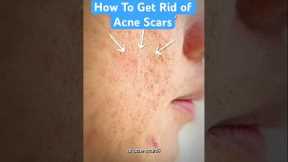 How To Get Rid of Acne Scars