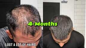 How I Reversed Hair Loss | 4 Months |  LifeOfNiravPatel