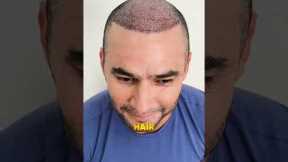 Five Months Hair Transplant Results | Latest Fue Technique #shorts #viral #hair transplant