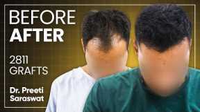 Hair Transplant Results, Cost, Before and After Time Lapse | Hair Transplant in Turkey vs India