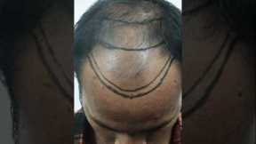 Hair Transplant Results [Before After] #hairtransplantinindia #viralvideo #shorts #hairtransplant
