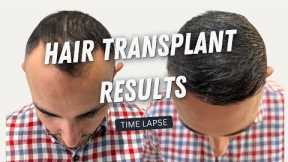 Hair Transplant Before and After | Hair Transplant Result 10 months | Hair Transplant Time lapse