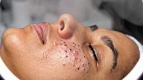 Blackhead Removal | #tweezers skincare #blackheads blackheads