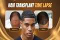 Hair Transplant Before and After: 12