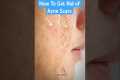How To Get Rid of Acne Scars