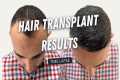 Hair Transplant Before and After |