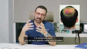 THE CROWN - Cracking the Code: Challenges of Crown Area Hair Transplants! 👑💇‍♂️