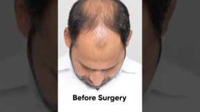 17 Months Hair Transplant Results | Latest Fue Technique #shorts #viral #hair transplant