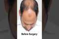 17 Months Hair Transplant Results |
