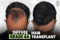Hair Transplant in Surat (HX-AQWT) |