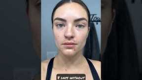 How my face changed with 8 days no alcohol #dryjanuary #sober #sobriety #shortsvideo #shorts