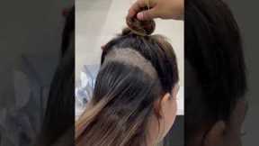 Female hair transplant | Dadu Medical Centre | Dr. Nandni Daddu