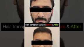 4100 Grafts Hair Transplant | Grade 3 Baldness Before & After Transformation