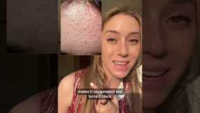 Best Ingredients for Acne Part 1 #shorts