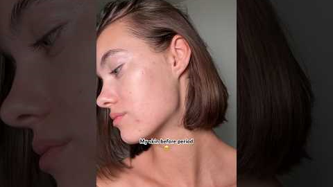 Skin before period 🥹😳#acneproneskin #acne #skincare #skincaretips #noncomedogenic #acnetreatment