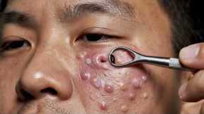 Blackhead Removal on Oily Skin | Deep Pore Cleaning