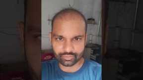 Hair Transplant 2 month result | Day1 to Day 60 Hair Transplant Timelapse | Rajan Singh