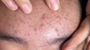 ASMR Deep Facial Cleansing & Blackhead Removal#acne 