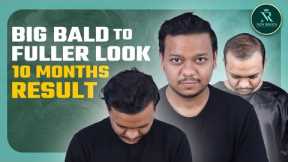 Month by Month Hair Growth 😍 | Hair Transplant in Bangladesh | New Roots