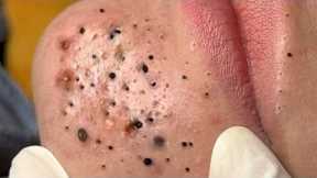 Calm Skincare Routine – Gentle Blackhead and Acne Cleaning - 219083