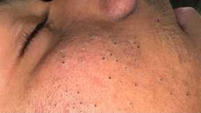 [ASMR] Clear Skin Therapy: Deep Cleansing and Pore Care