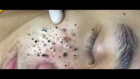 Deep Pore Blackhead Removal – Satisfying Acne Extraction & Relaxing Skincare - 234126